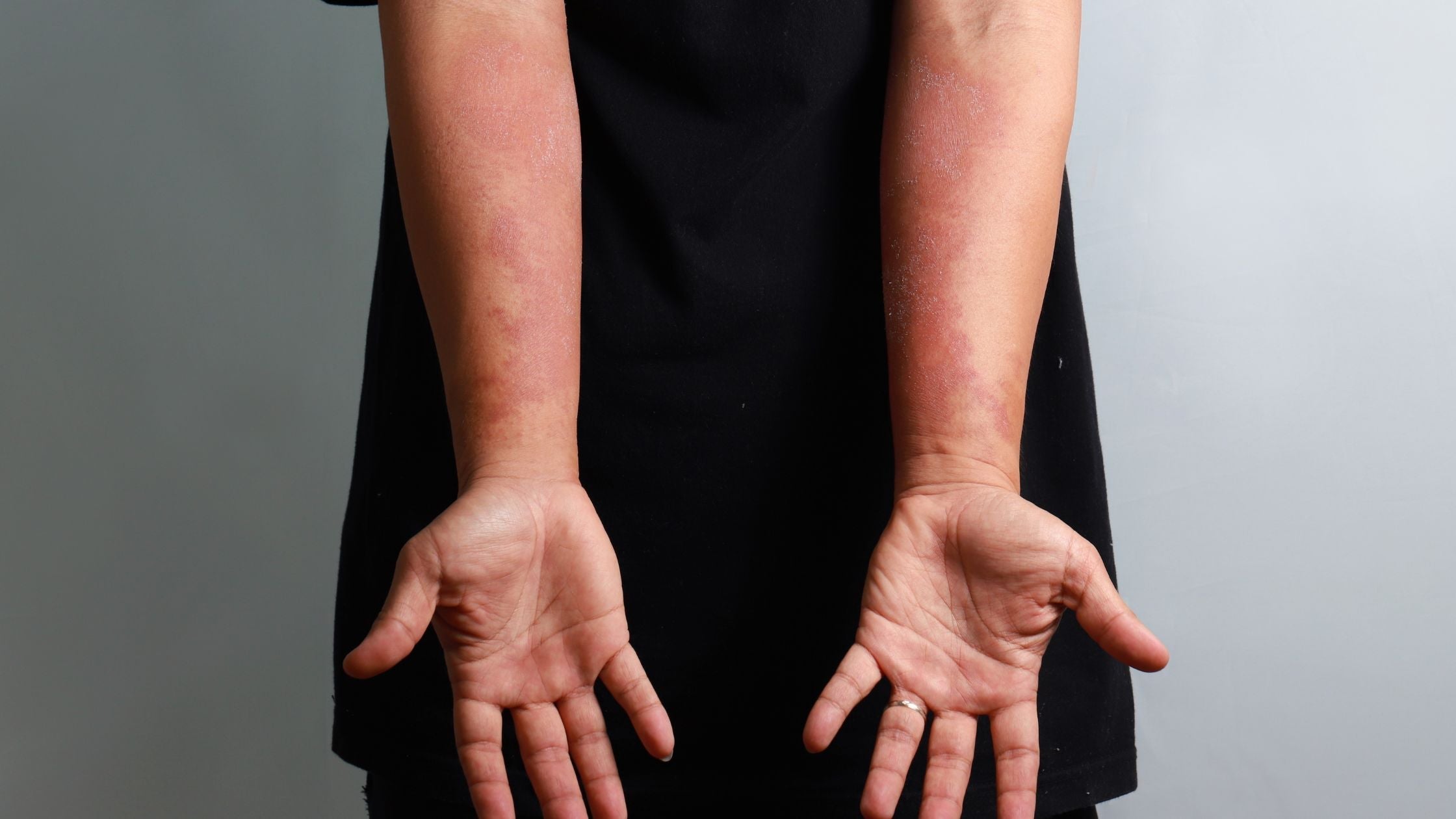 person standing out of shot with elbows and hands facing forward showing eczema down arms