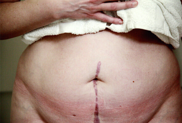 When Can You Shower After C Section?