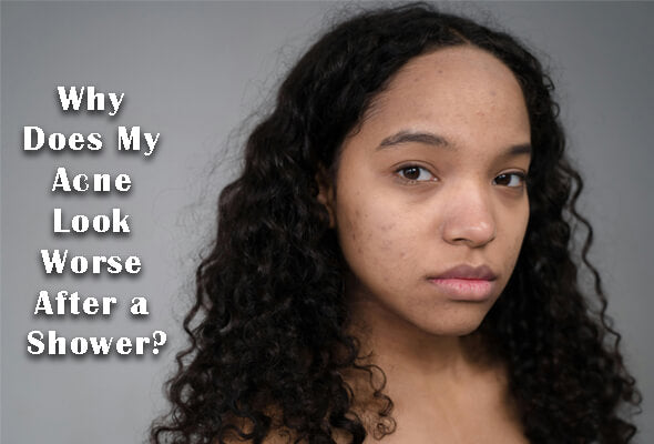 Why Does My Acne Look Worse After a Shower?