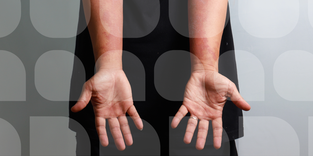 Both palms held open facing upward, showing eczema-affected skin with red, inflamed patches on the wrists and forearms