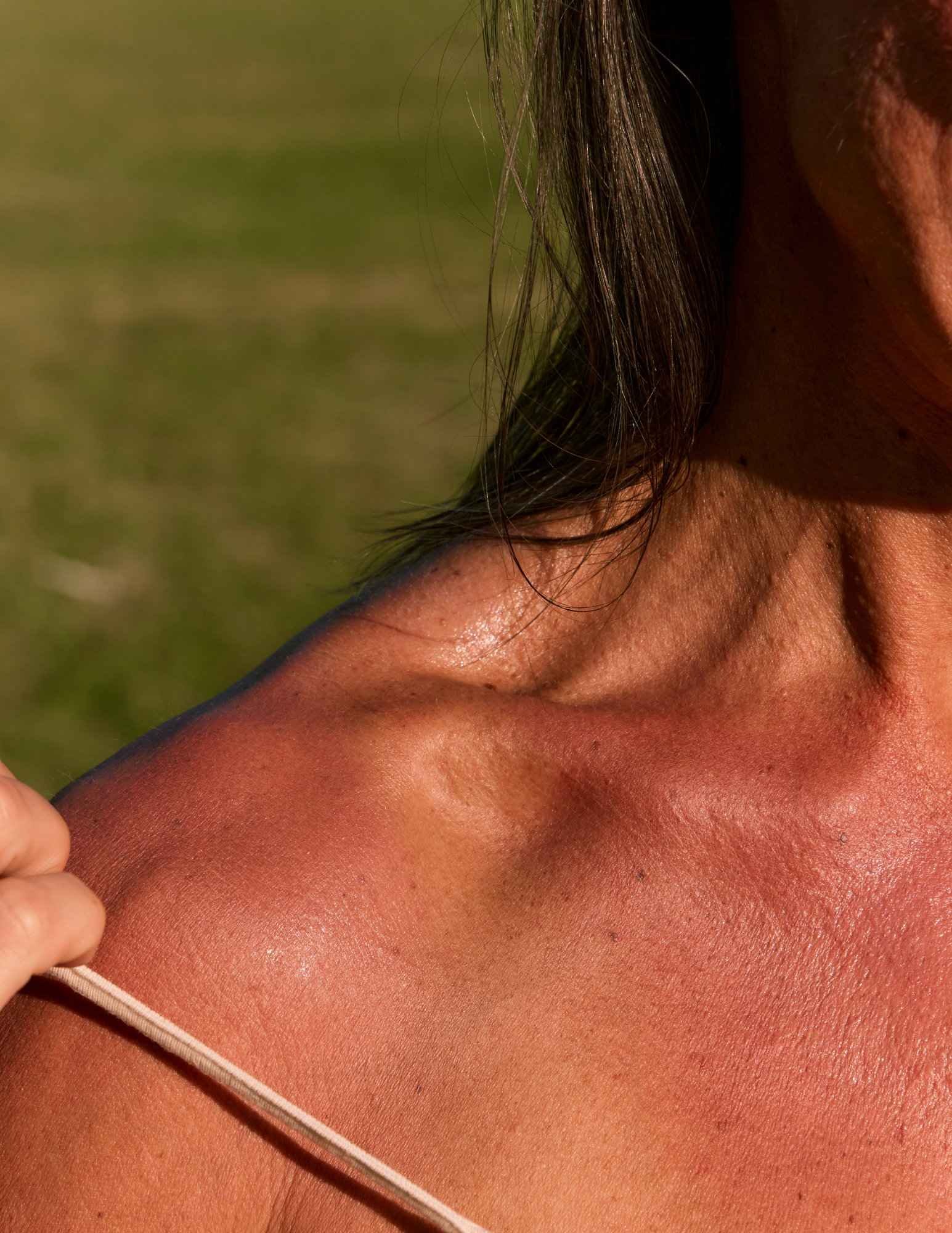 Hot or Cold Shower for Sunburn: What Works Best?