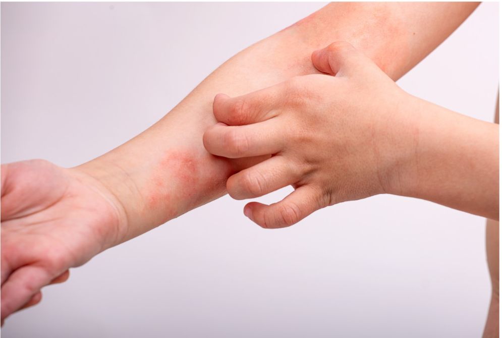 Eczema Awareness Month: What You Need to Know About Showering and Flare-Ups