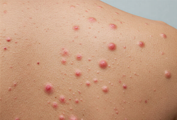 How to Get Rid of Back Acne
